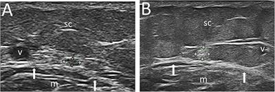 Sural Nerve Size in Fibromyalgia Syndrome: Study on Variables Associated With Cross-Sectional Area